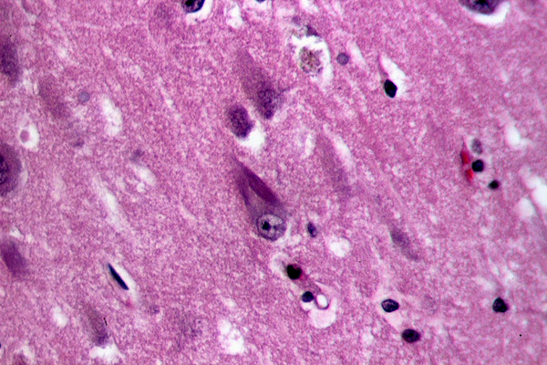 Ovillos neurofibrilares en el hipocampo de una persona anciana con alzhéimer. Imagen: Wikipedia 